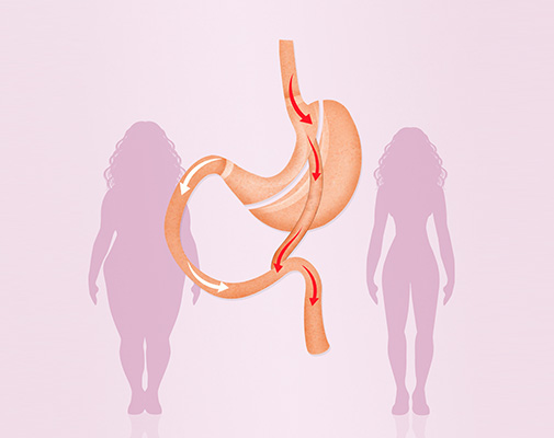 Gastric Bypass